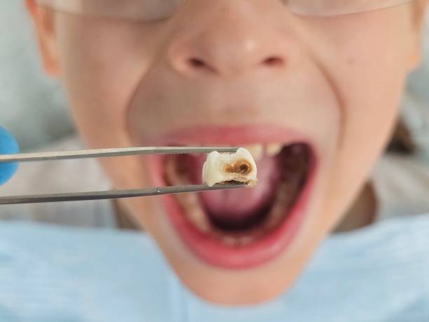 Best Emergency Treatment for Dental Infections or Abscesses in Martins Additions, MD